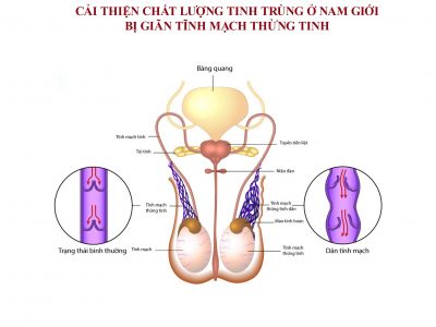 Cai-thien-chat-luong-tinh-trung-o-nam-gioi-bi-gian-tinh-mach-thung-tinh